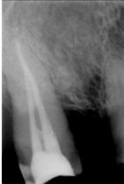 Zdjęcie zęba 2- kanałowego po leczeniu